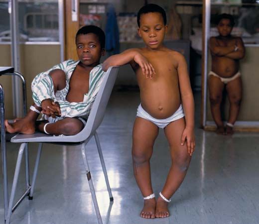 children with rickets